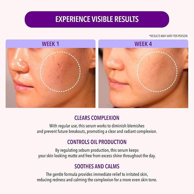 10% Niacinamide and 1.9% Salicylic Acid Oil Control Serum