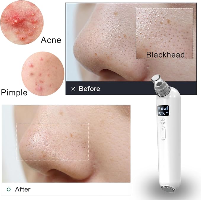 Blackhead Remover Vacuum White
