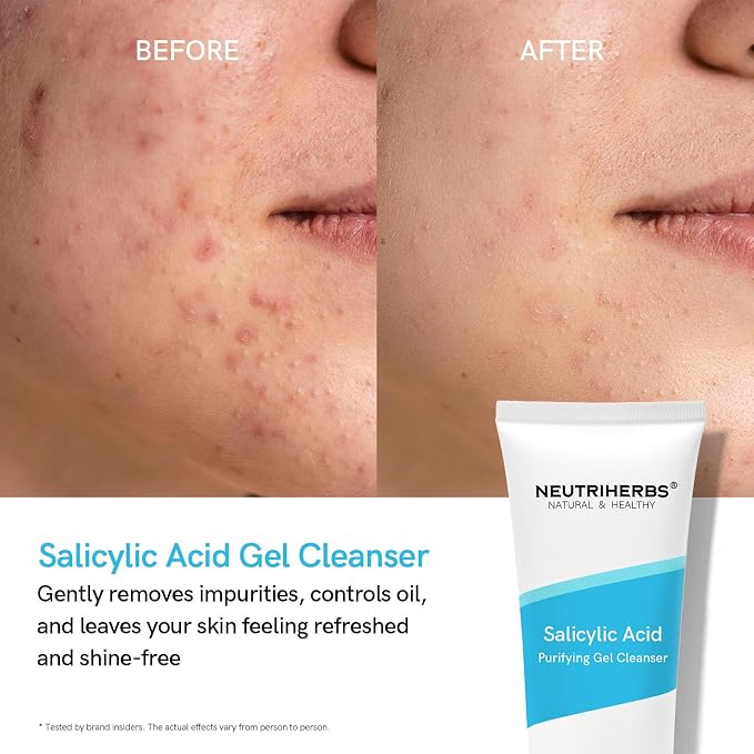 Salicylic Acid - Improve Acne-prone Skin