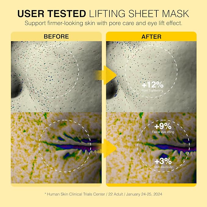 Pore Lifting