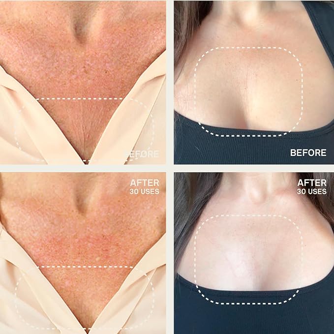 Chest and Decollete Patch
