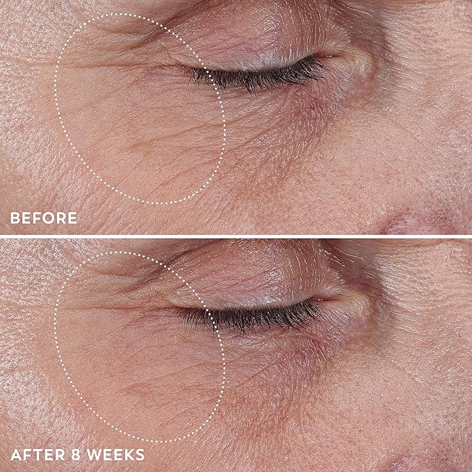 Eye Wrinkle Treatment